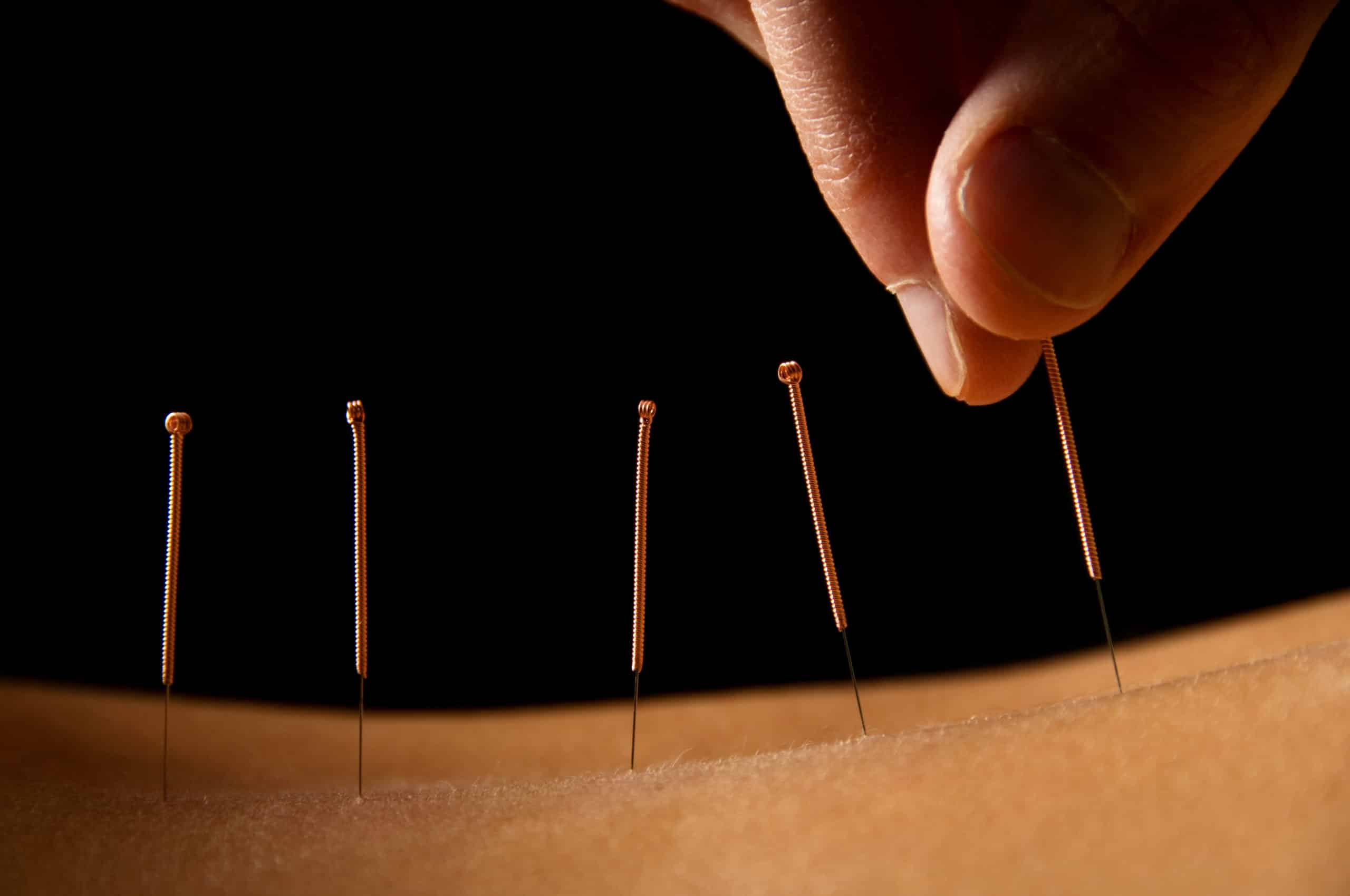 Triumph Physio clinician putting acupuncture needles in the back