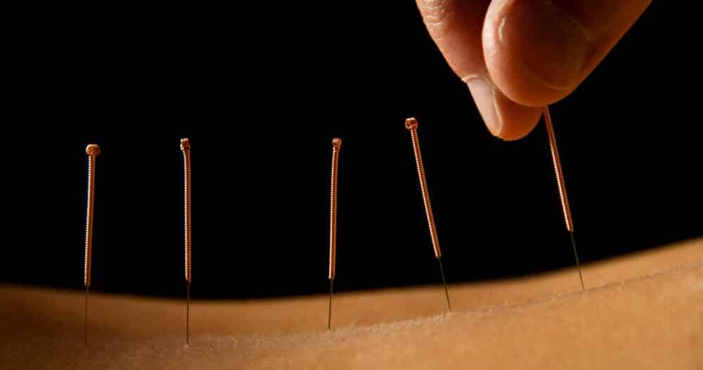 Acupuncture Acupuncturist inserting acupuncture needles in the the skin