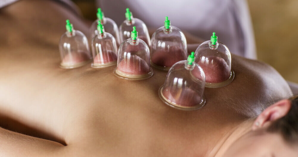 Cupping Women relaxing with cupping after acupuncture treatment
