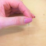 Acupuncture can help manage your stress