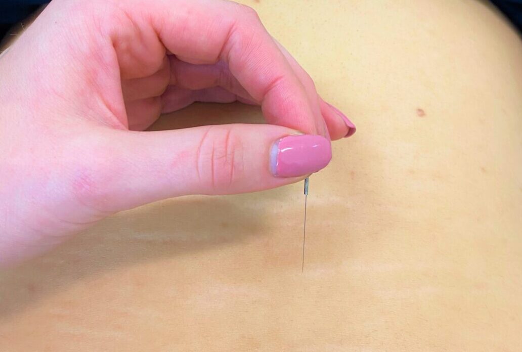 Read more about the article Acupuncture can help manage your stress