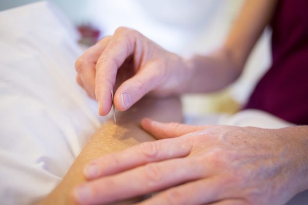 What is dry needling?