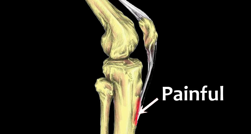 knee pain for osgood-schlatter