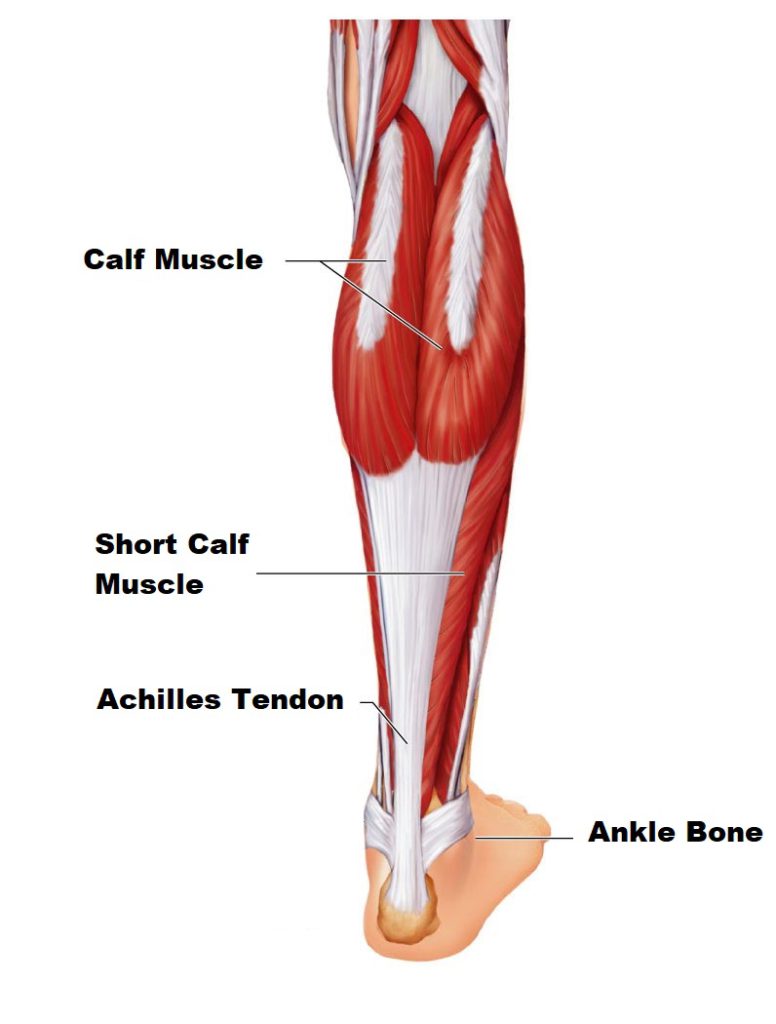 achilles tendinopathy