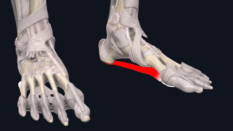 Plantar Fasciitis