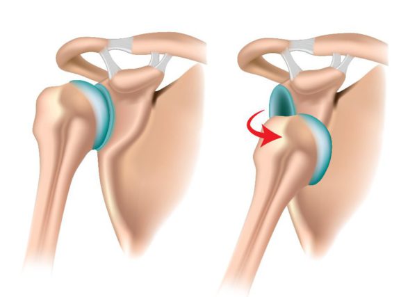 Read more about the article Anterior Shoulder Dislocation
