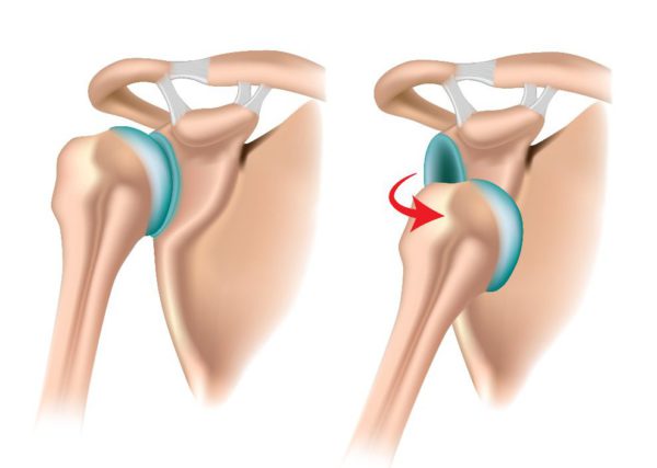 You are currently viewing Anterior Shoulder Dislocation