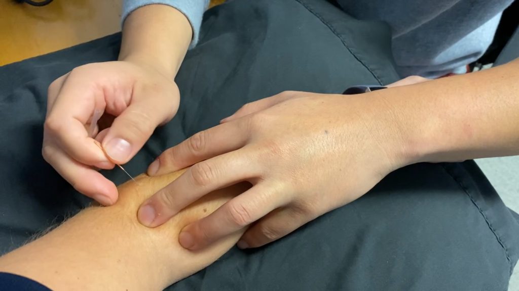 physiotherapist holding a acupuncture needle ready to dry needle a patients forearm