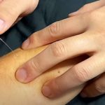 Dry Needling: Treatment for Muscle Pain and Stiffness