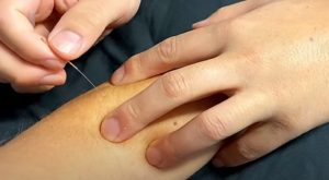 Read more about the article Dry Needling: Treatment for Muscle Pain and Stiffness
