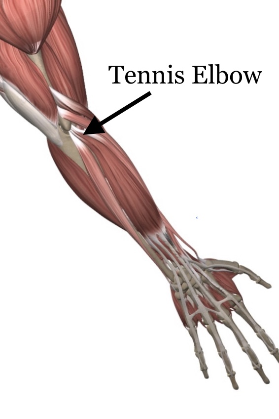 picture of forearm muscles with an arrow pointing to tennis elbow pain location