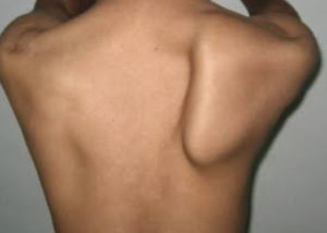 showing right scapula winging. scapula is protruding out