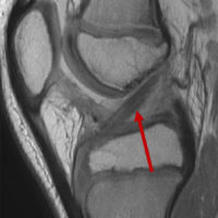 Post-Surgical Physiotherapy Services in Auckland: Your Guide to Recovery After Anterior Cruciate Ligament (ACL) Reconstruction
